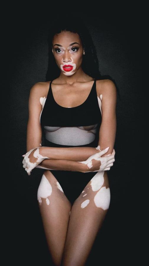 Winnie Harlow